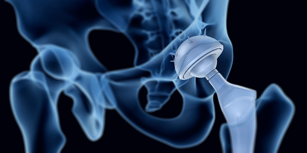 Hip implant illustration
