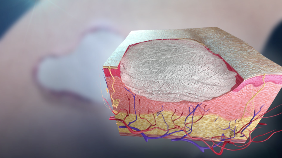 Illustration of a wound being treated with borate-based bioactive glass